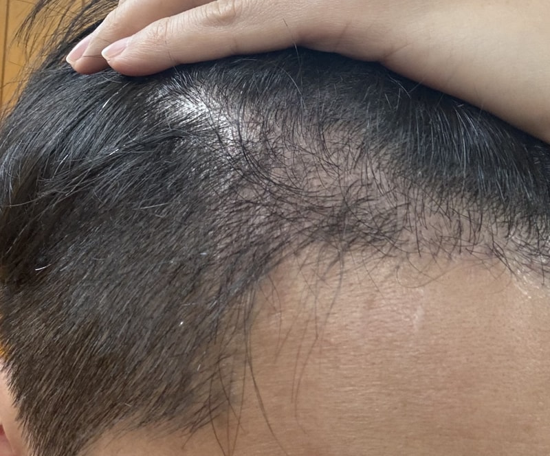 블랙포레(쿨&딥클린) - [2주차 후기] 모발 이식 부위 두피 상태 및 모낭염 상태 확인