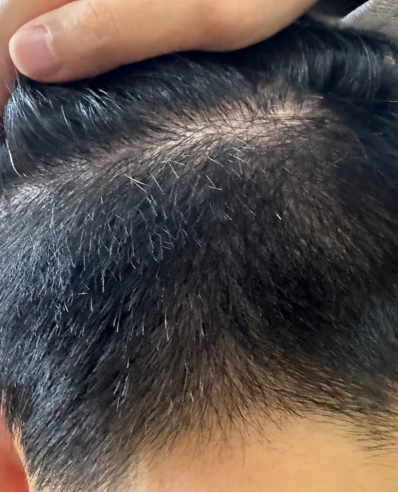 [1주차 + @] 모발 이식 후 사용 후기