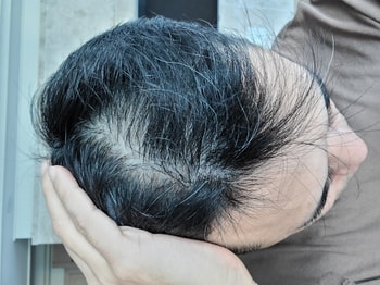  최대 고민부위 정수리 부위 사용전 사진입니다. 이제 시작하는 주다보니 크게 느끼는건 없습니다만.두피가 점점 탄력을 받는듯합니다.같은샴푸 같은 방법으로 꾸준히 사용 하며 주차 후기 올려보겠습니다.