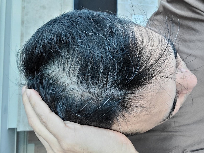  최대 고민부위 정수리 부위 사용전 사진입니다. 이제 시작하는 주다보니 크게 느끼는건 없습니다만.두피가 점점 탄력을 받는듯합니다.같은샴푸 같은 방법으로 꾸준히 사용 하며 주차 후기 올려보겠습니다.