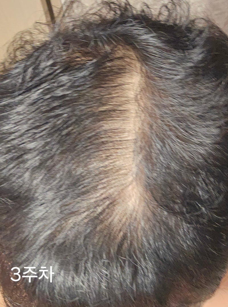 마이녹셀 3주차후기