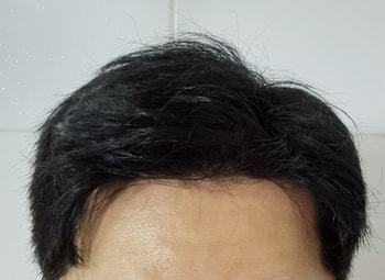 스칼프 사용 이후