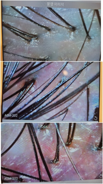 무료 두피 진단