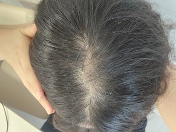 탈모가 심각한 정수리