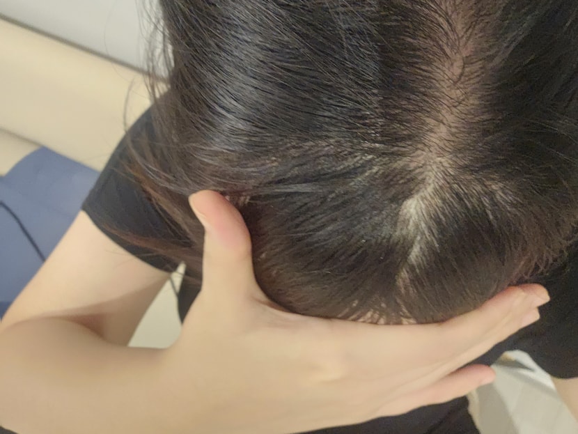 두피 상태