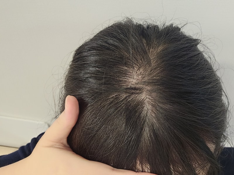 TS 더뉴프리미엄 탈모샴푸 2주차 후기