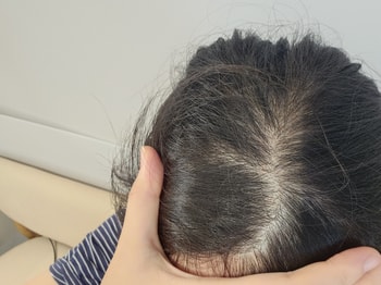 사용 전 두피 상태