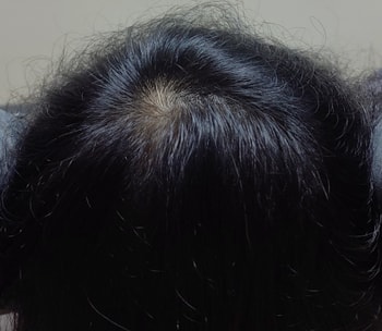 머리를 숙이고 촬영한 현재 머리 상태ㅠ