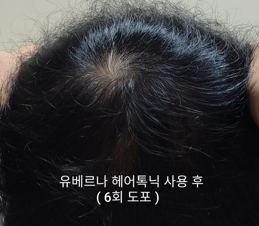 유베르나 헤어토닉 사용 후