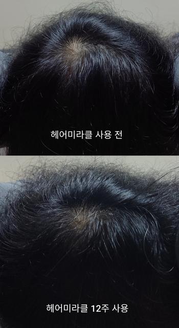 정수리에 희망이 보이는 듯 합니다@@