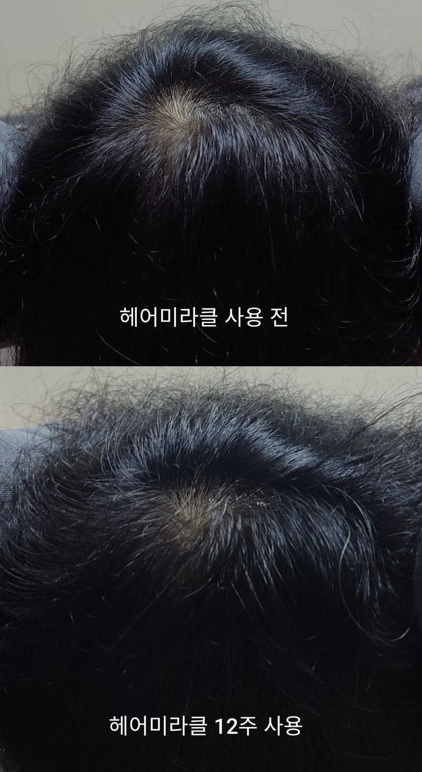 정수리에 희망이 보이는 듯 합니다@@