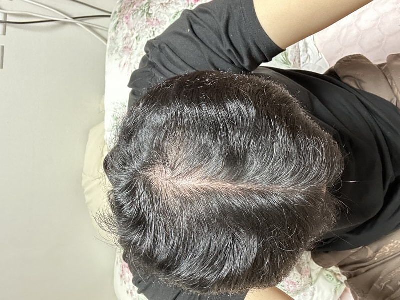 [3周] Mirina 头皮护理 套装使用记
