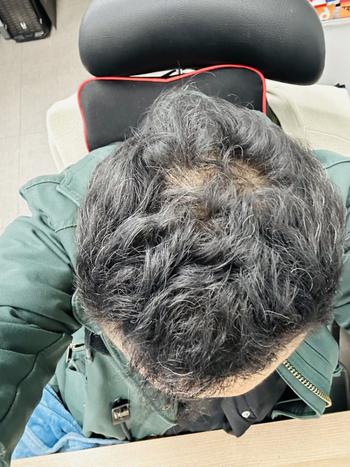 더마시모 사용 직전