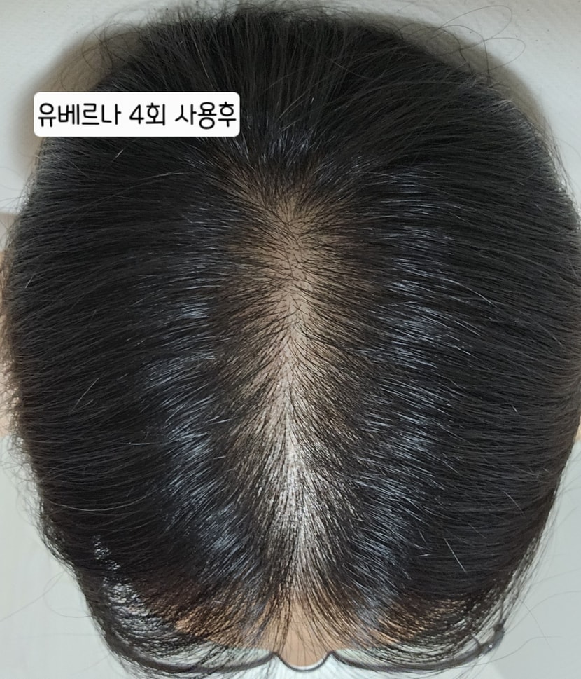 두피상태
