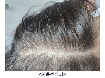 스카비올 사용전 두피