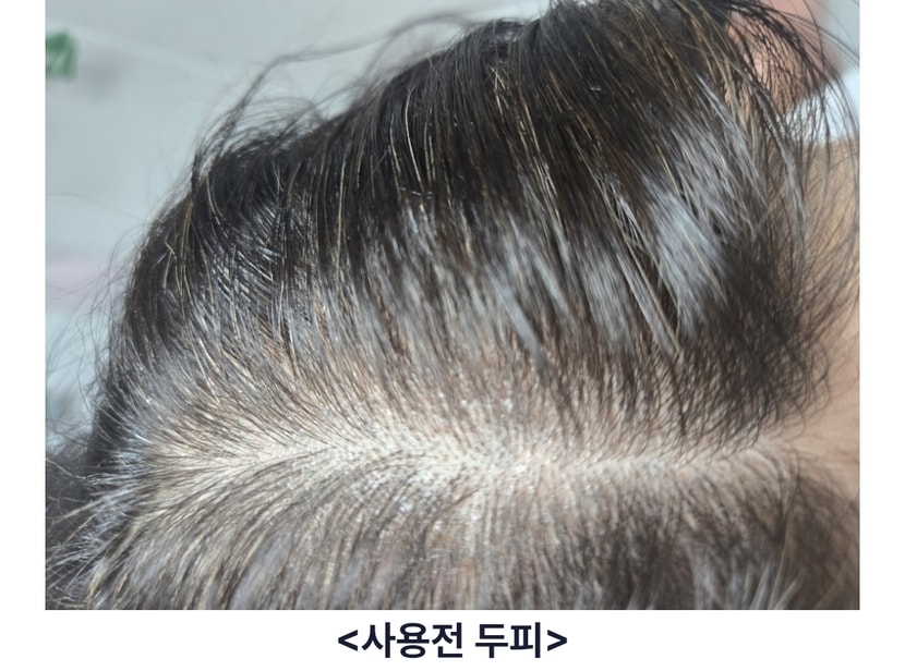 스카비올 사용전 두피