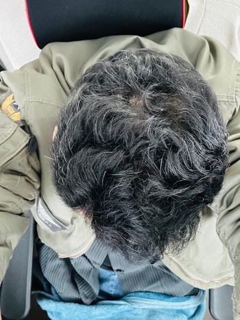 더마시모 사용 4주차