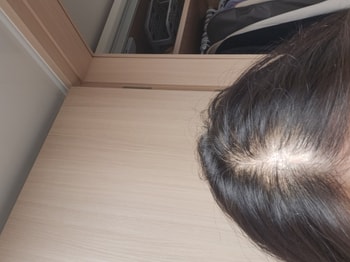 스마트폰카메라로 찍어본 3주차 정수리상태입니다. 언뜻봐선 모르겠지만 저는 머리가 좀 채워진거같고 전보다는 휑해보이지않는다는게 좀 효과가 있는 거 같습니다. 꾸준히 바르면 효과가 더욱 커질것같습니다.