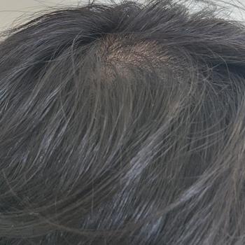 메디헤어 사용 후 정수리 사진