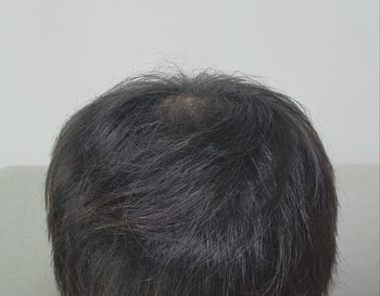 메디큐브 사용 1개월