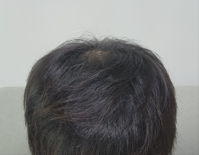 메디큐브 사용 1개월