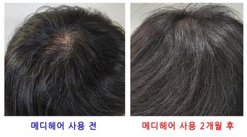 2개월 전후 사진