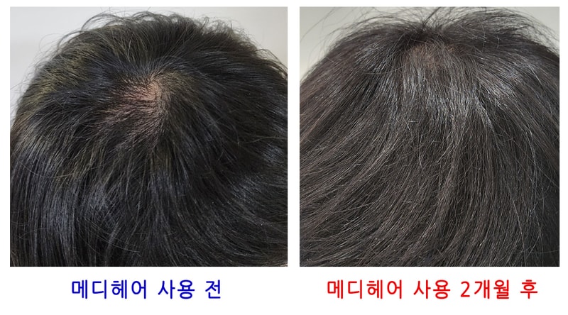 메디헤어 사용 2개월 전/후 한번 공유 드립니다. (11/24)