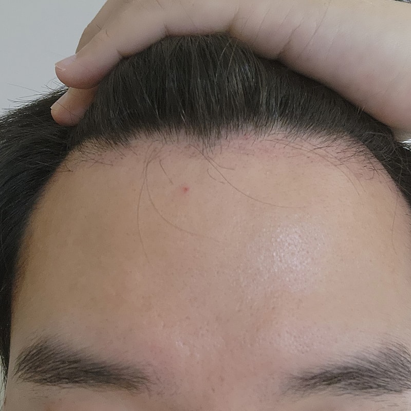 毛髪移植7週目のメディヘアを使用しています！！ (18/24)