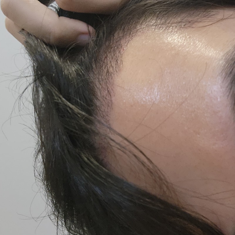 M字移植2週間後メディヘアを使用しています！！ (14/24)