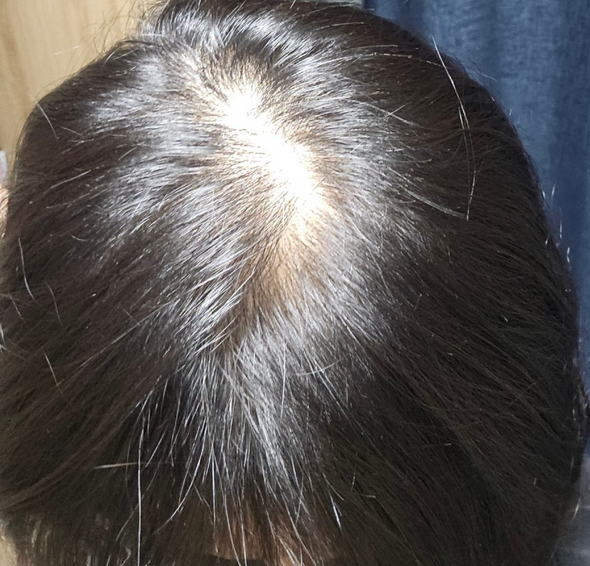 두피.. 아직은 부족하지만