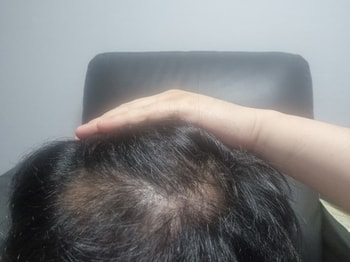 잔털도 많아지고 깨끗해진 두피입니다 ㅎㅎ 