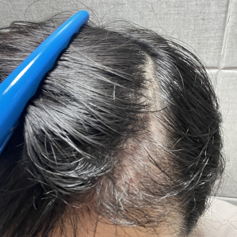 처음 2일차 때 두피입니다. 제가 두피가 예만한 스타일이라 항상 가렵고 빨갛게 되는데요. 시원해서 아침마다 발라주고 있습니다! 