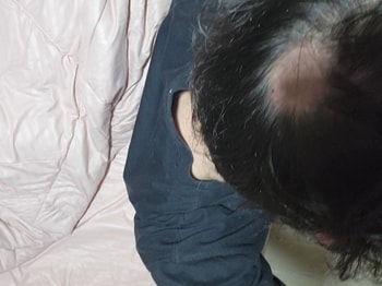 머리가 몇일전 햇빛에 장기간 노출되고 다음날 피부가 탄것처럼 닿으면 아팠는데 몇일 있으니 두피에서 껍질이 벗겨지더니 하루만에 머리가 빠지고 땜빵이 났어요