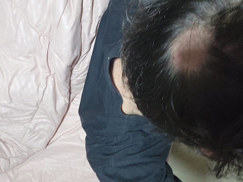 머리가 몇일전 햇빛에 장기간 노출되고 다음날 피부가 탄것처럼 닿으면 아팠는데 몇일 있으니 두피에서 껍질이 벗겨지더니 하루만에 머리가 빠지고 땜빵이 났어요