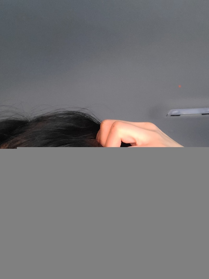 M자 잔머리 약으로 해결될까요?