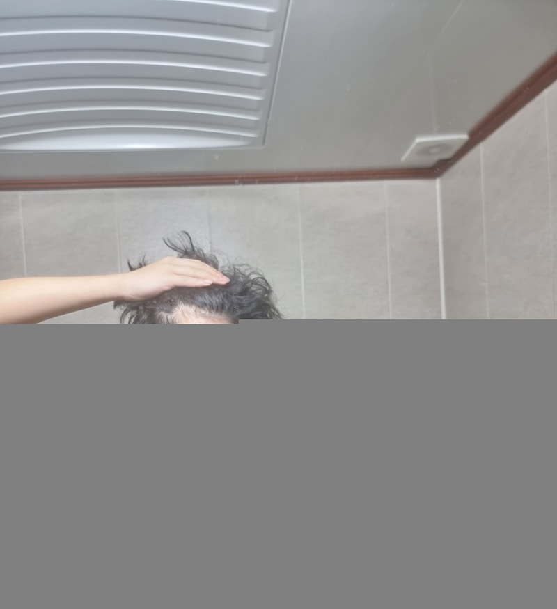 M-shaped hair loss question