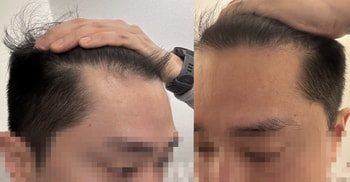좌우 앞 이마라인
