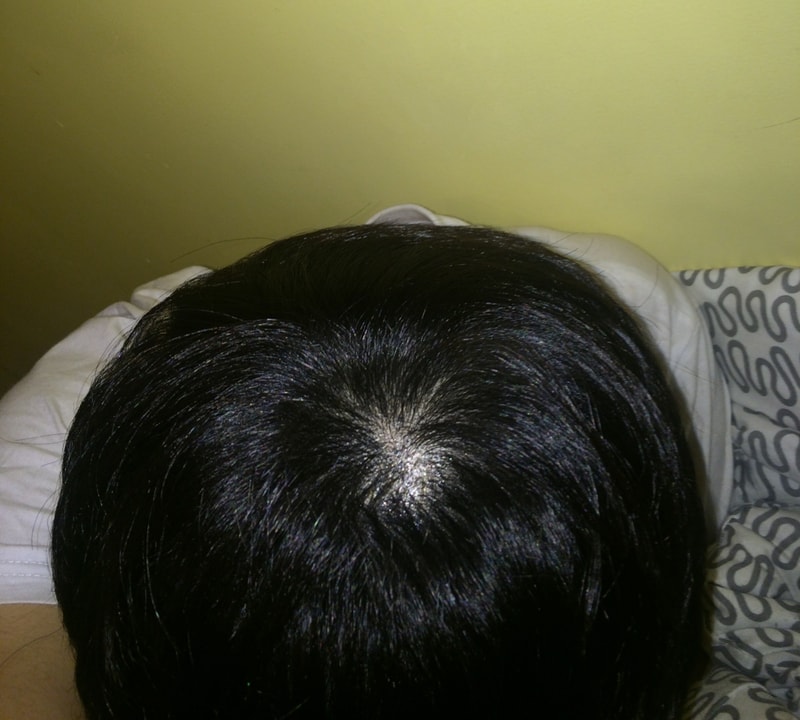 정수리 모발이식이요