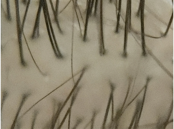 호르몬 영향 없는 뒷머리 확대 사진