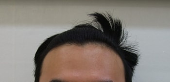 수술전