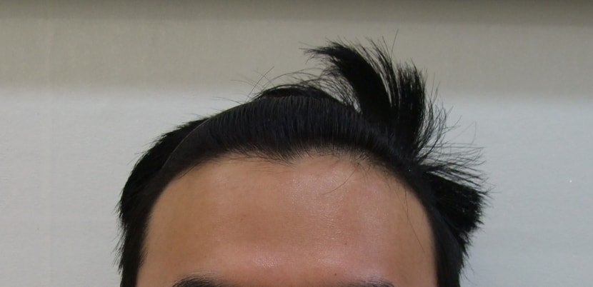 수술전