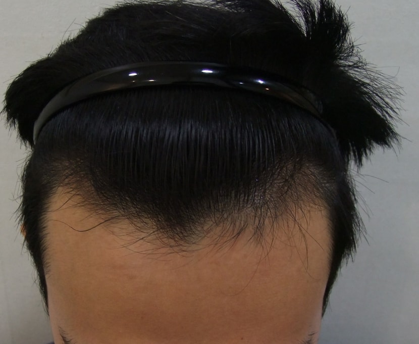 수술전
