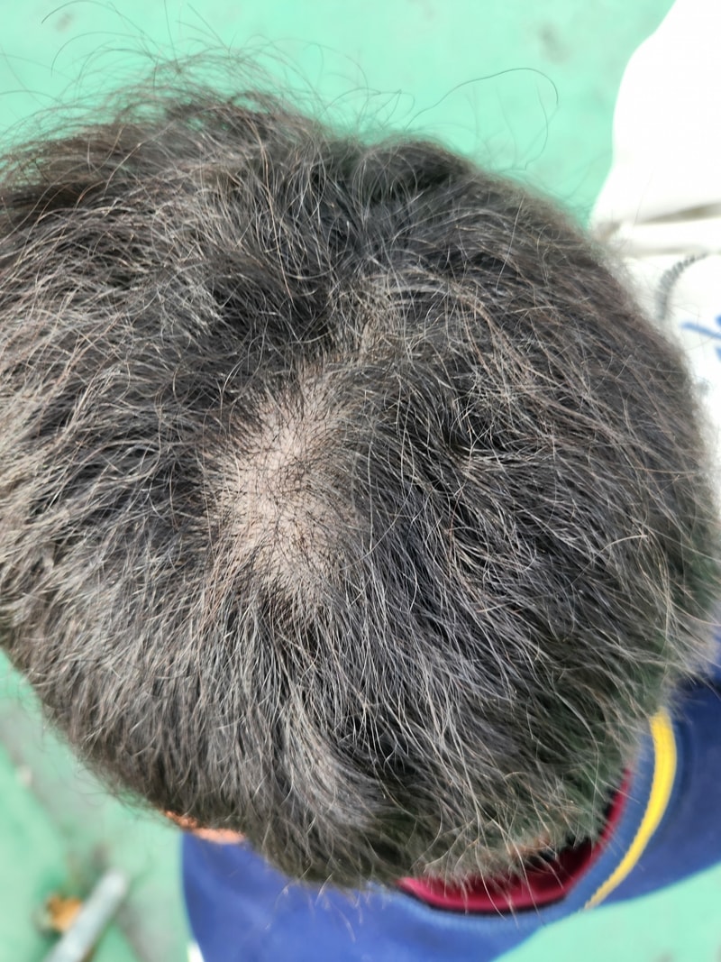 Is it hair loss on the top of my head?