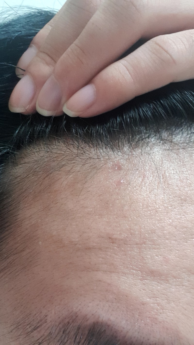 我21岁了，会脱m型吗？