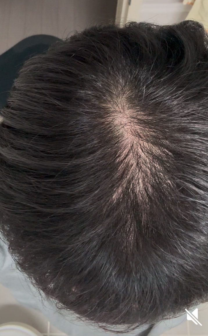 Please diagnose hair loss on the top of your head