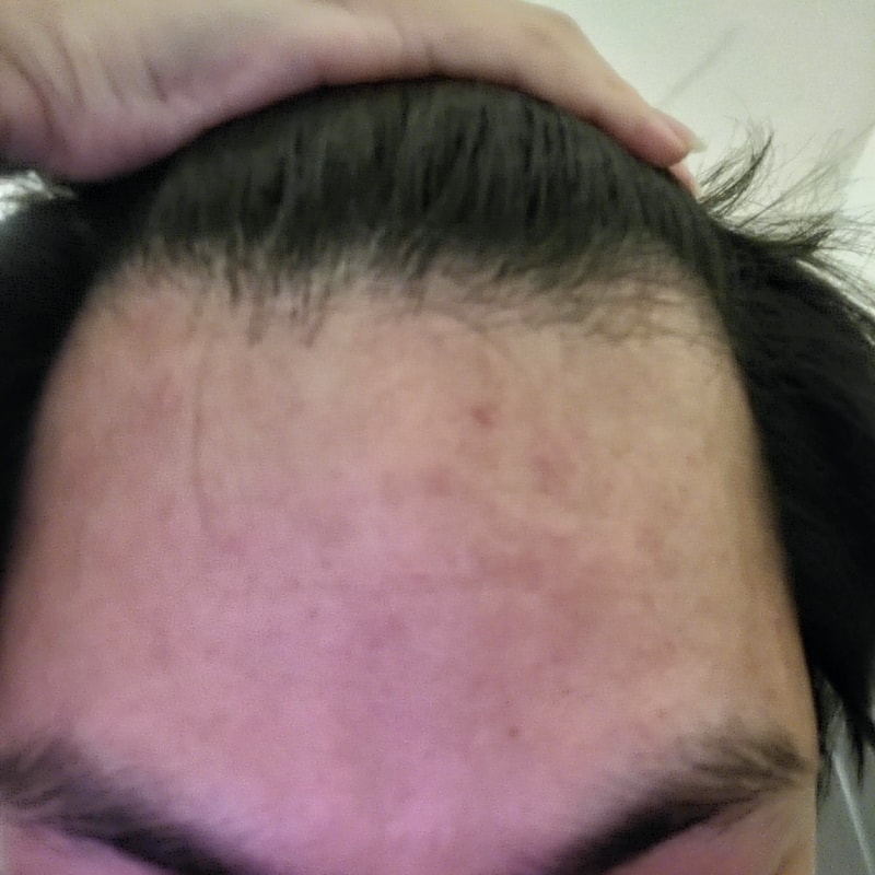 탈모 확인부탁드립니다