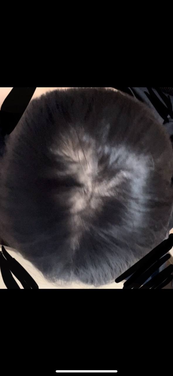 정수리 탈모인가요?