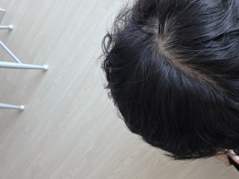 The top of my head... Is it hair loss?