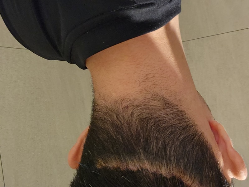 Even if it's re-sealed, the wound is huge. Can we improve it?