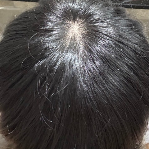 탈모인가요...?
